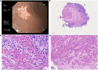 Crystal-storing histiocytosis in the stomach: A case report and review of the literature